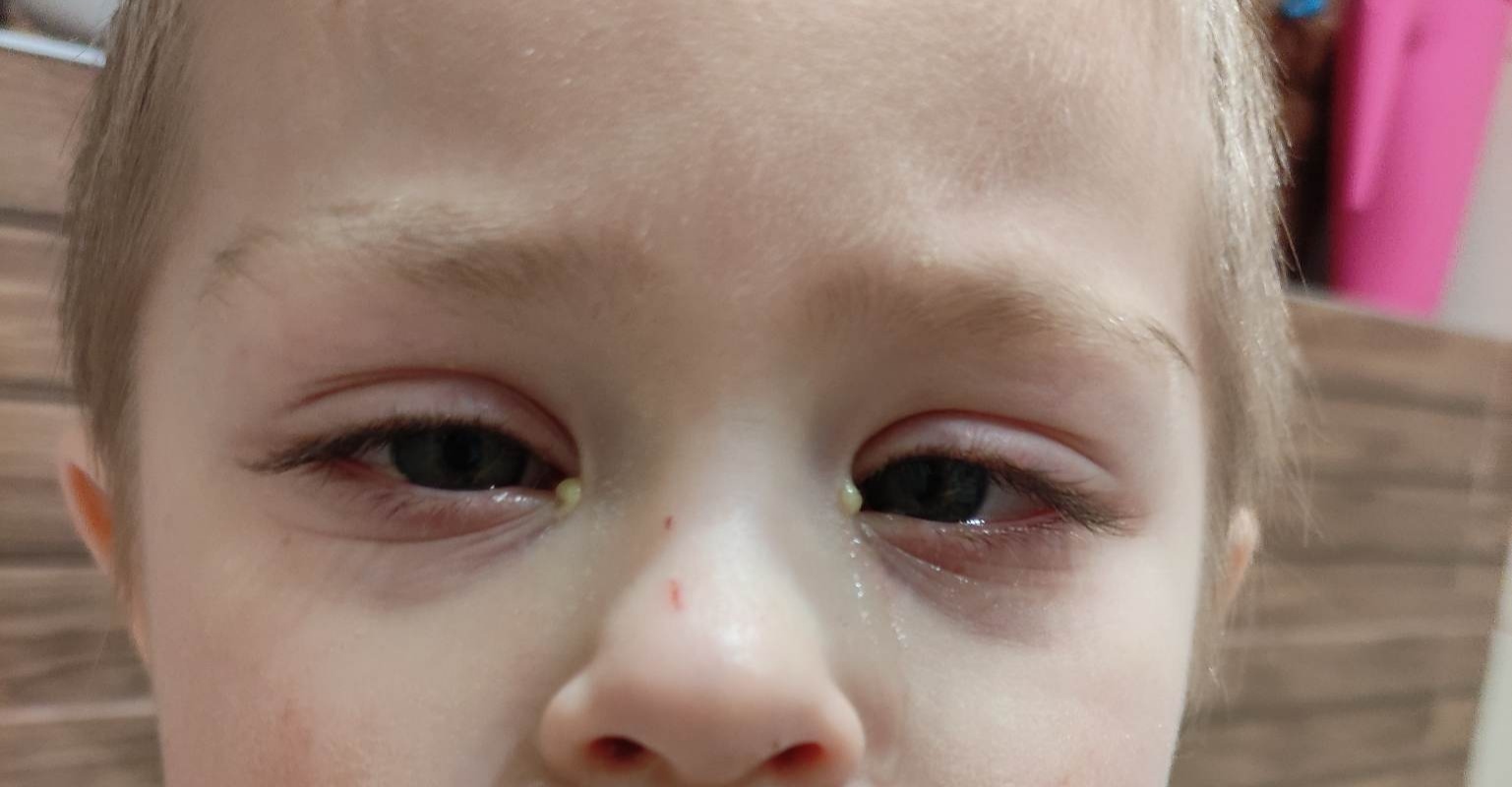 ak dieťa trpí zápalom očných spojoviek, tak sa u neho vyskytne slzenie a výtok, ktorý je hnisavý a väčšinou zelenej farby.