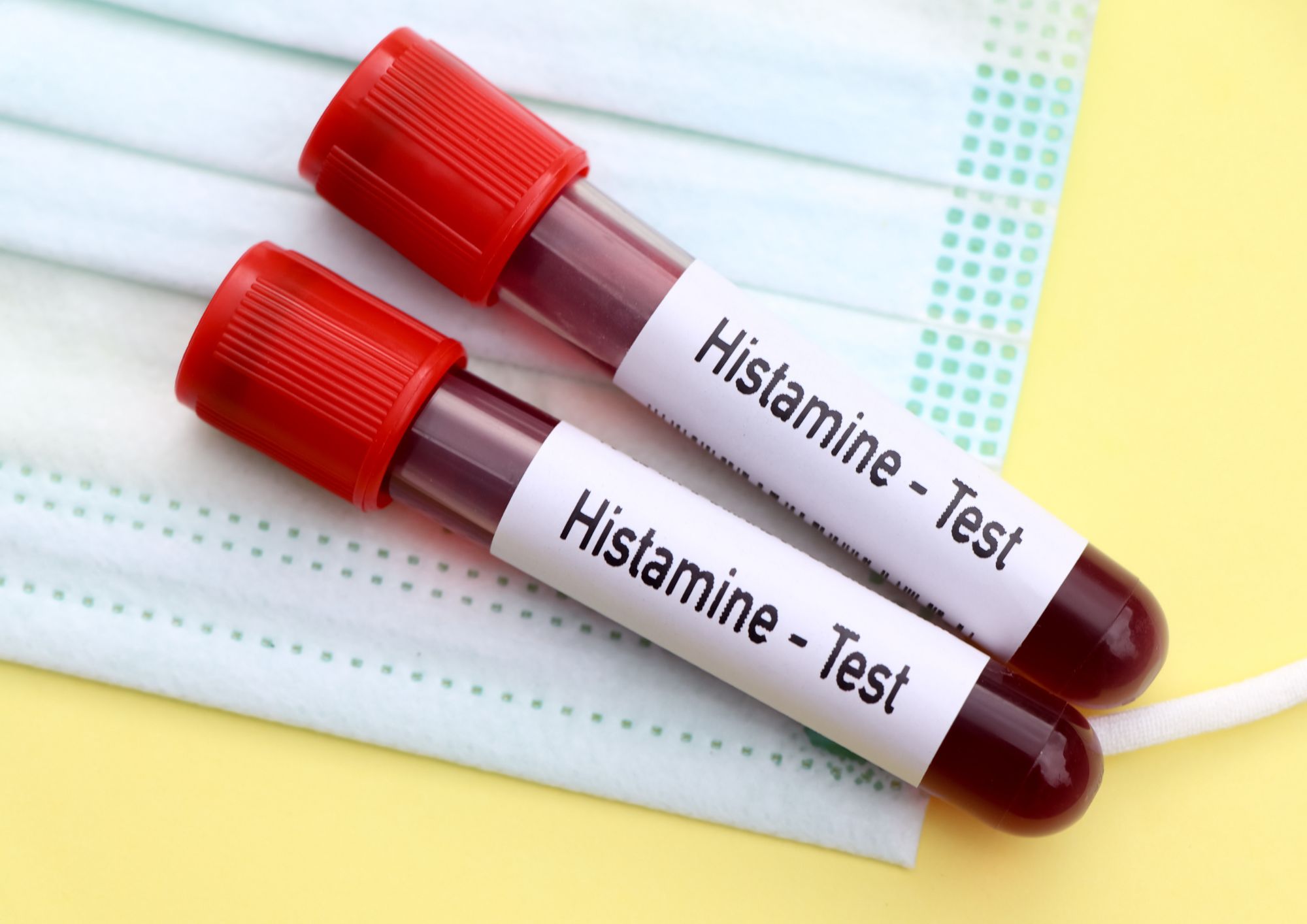 histaminova intolerancia a vyšetrenie