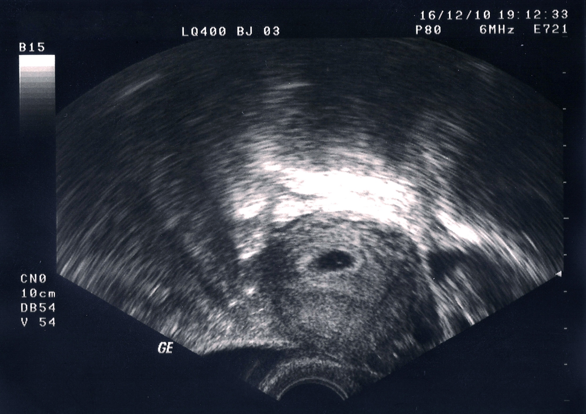 UTZ v 4. týždni tehotenstva. Viditeľný môže byť žĺtkový vak.