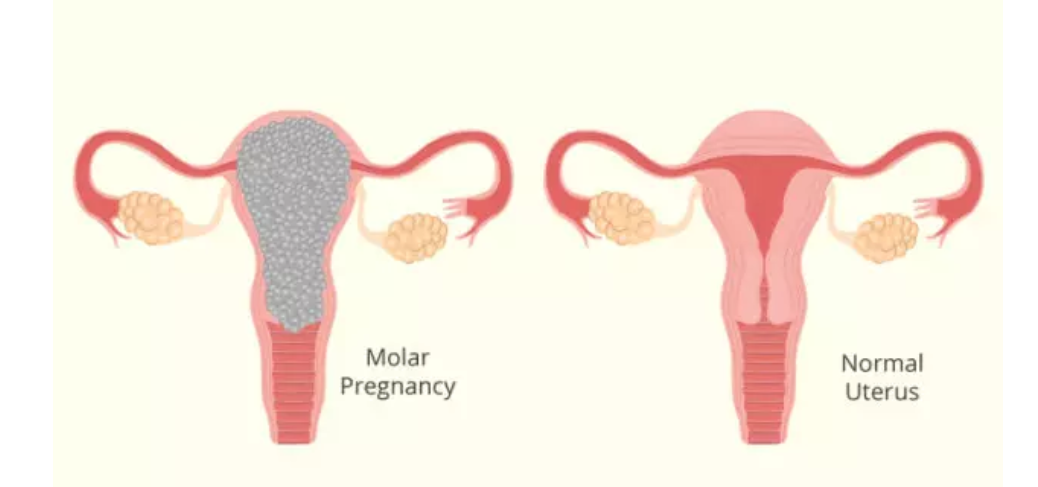 molárne tehotenstvo ukážka