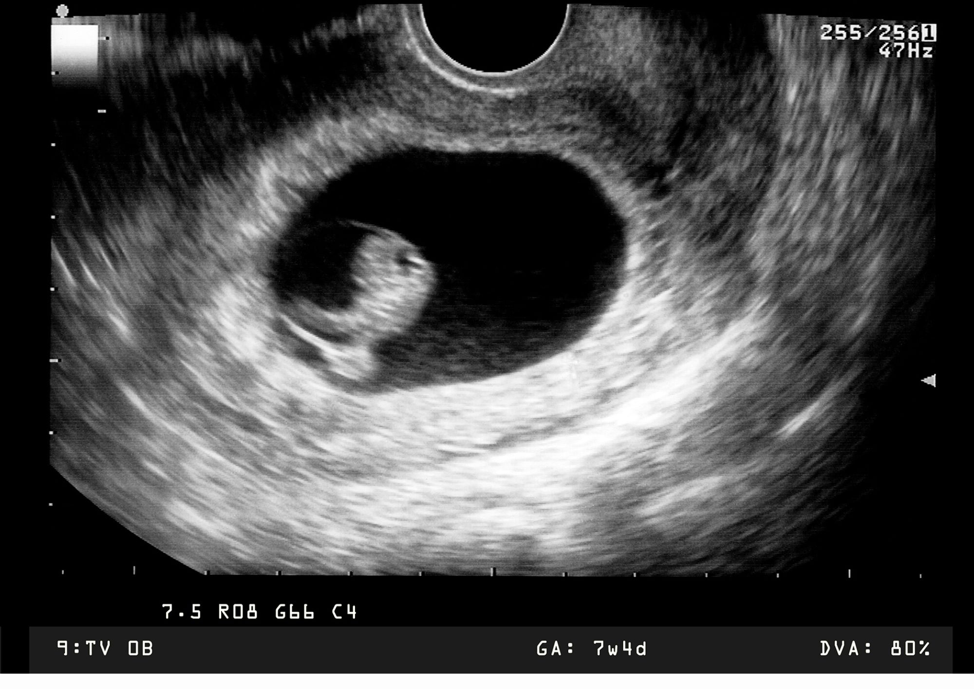 8týždeň tehotenstva ultrazvuk