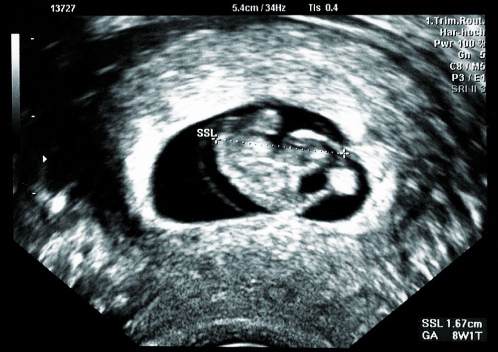 Ultrazvuk embrya v 9. týždni