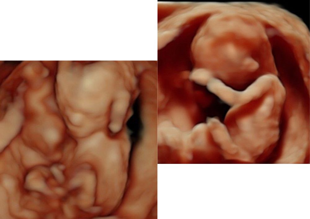14._týždeň_tehotenstva_a_4D_ultrazvuk[1]
