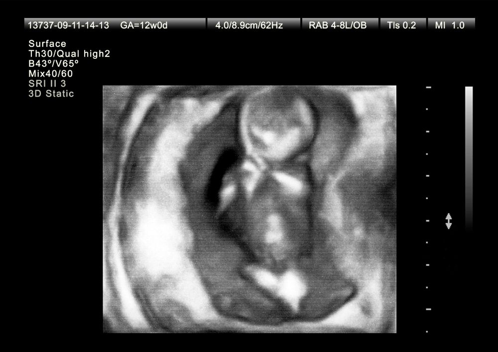 Ultrazvuk 12. týždeň tehotenstva