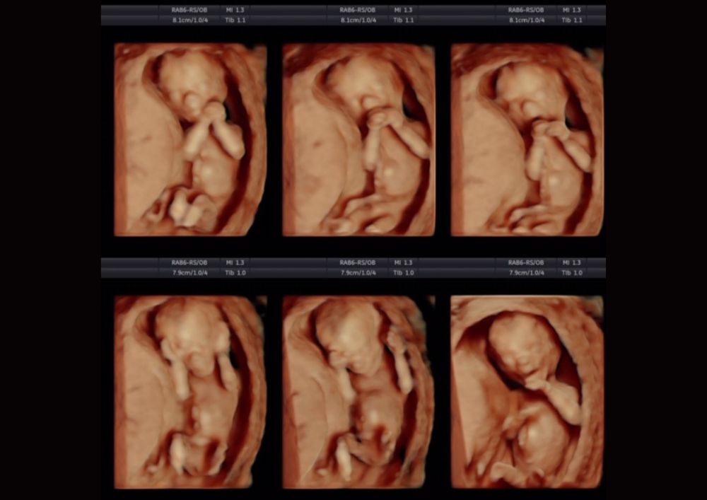 15._týždeň_tehotenstva_ultrazvuk