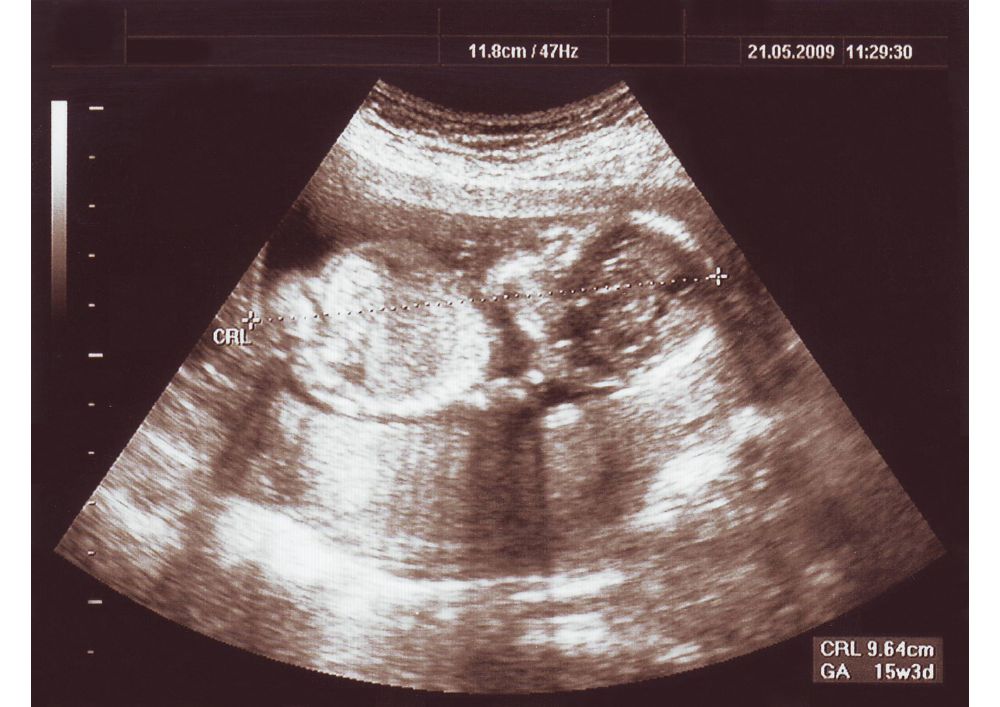 Ultrazvuk_v_16._týždn_tehotenstva[1]
